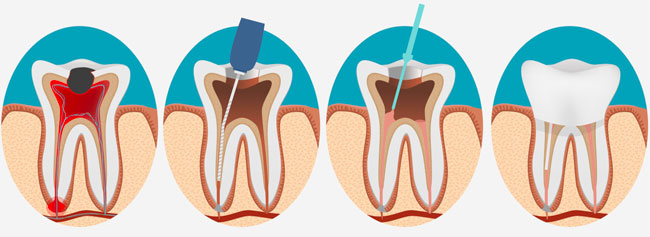 Лечение пульпита
